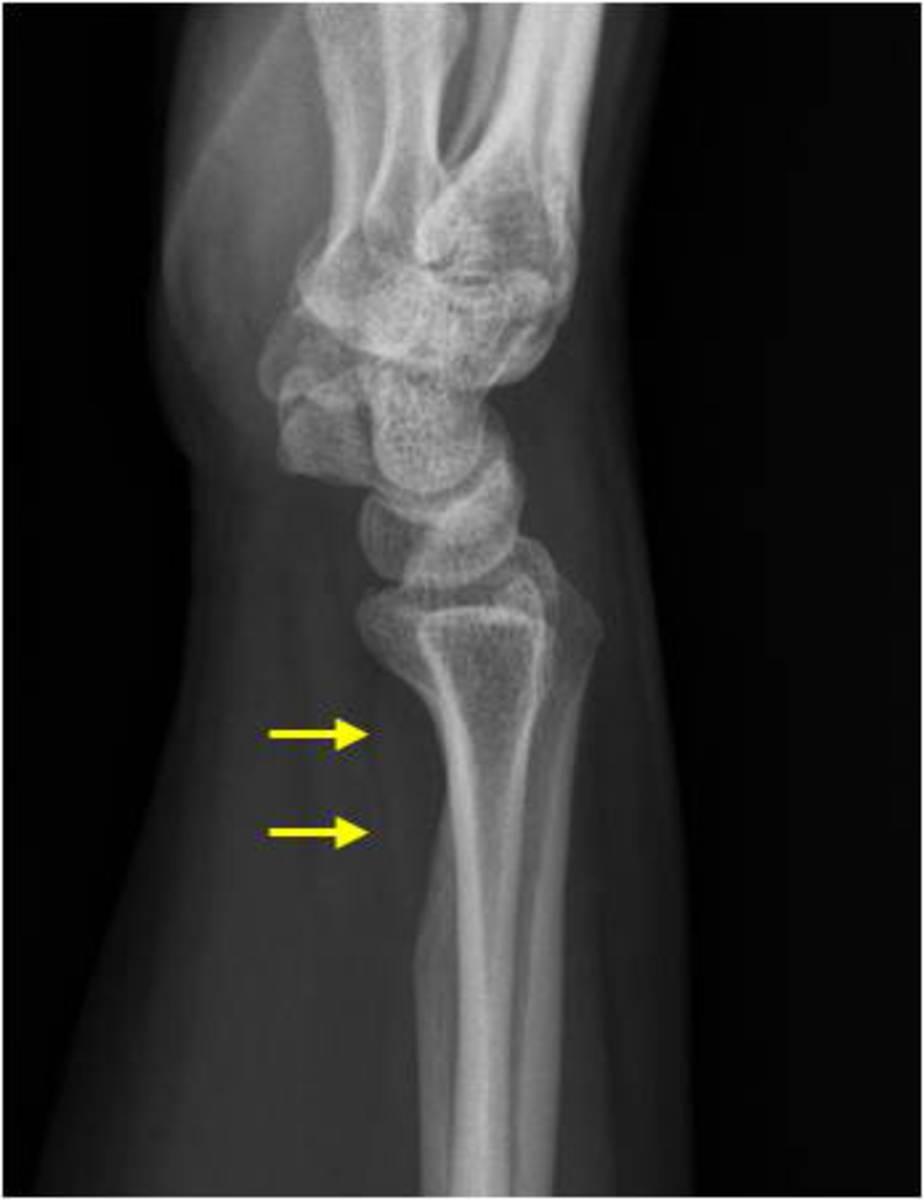 Fig. 12: Normal: Lateral wrist radiograph.