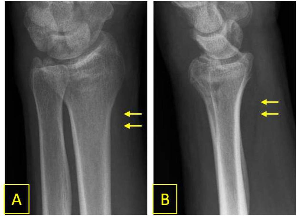 Fig. 13: Oblique (A) and lateral (B) radiographs of the wrist showing convex