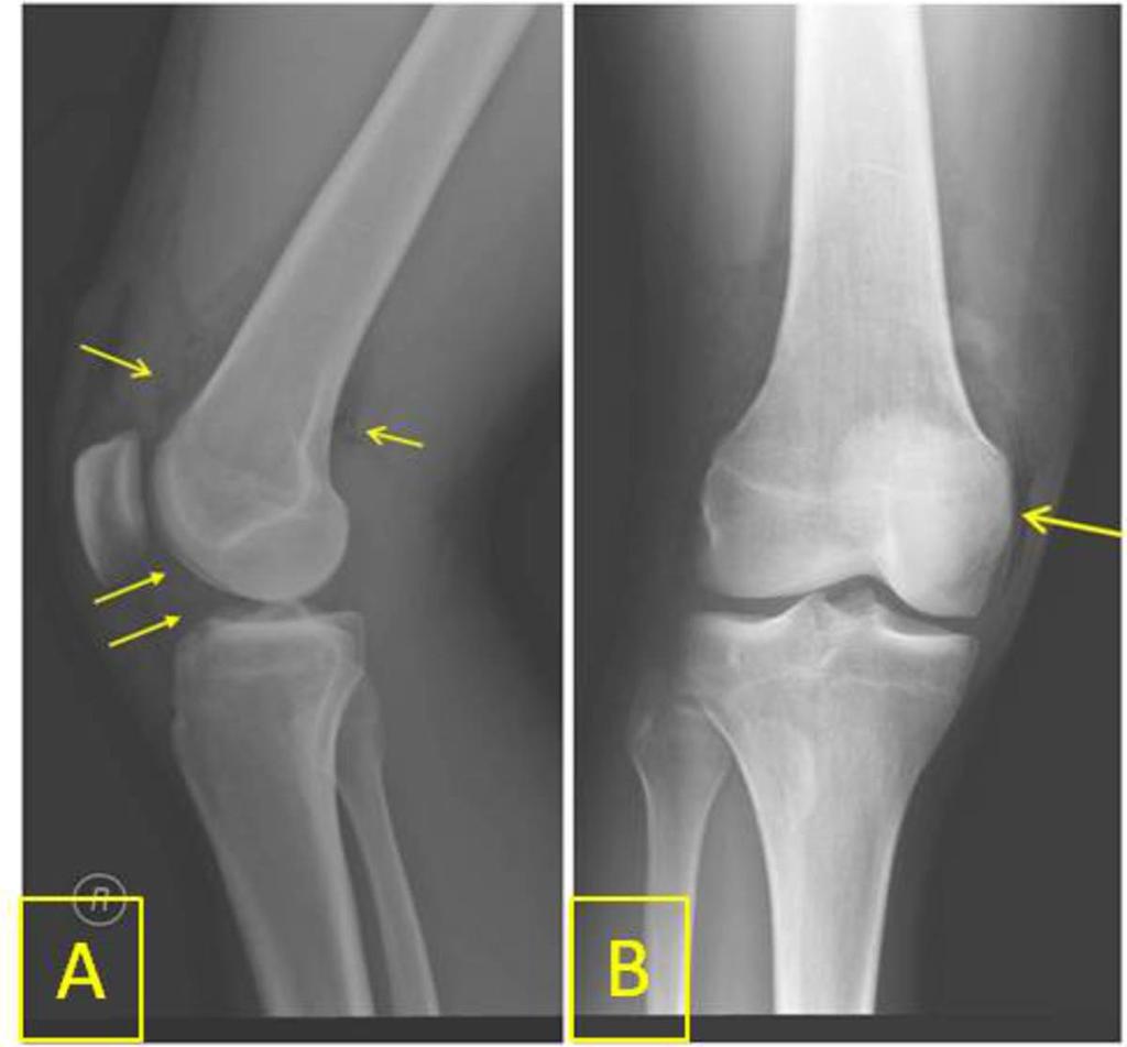 Fig. 1: Normal: Lateral knee radiograph. Hoffa's fat pad is outlined. Fig.