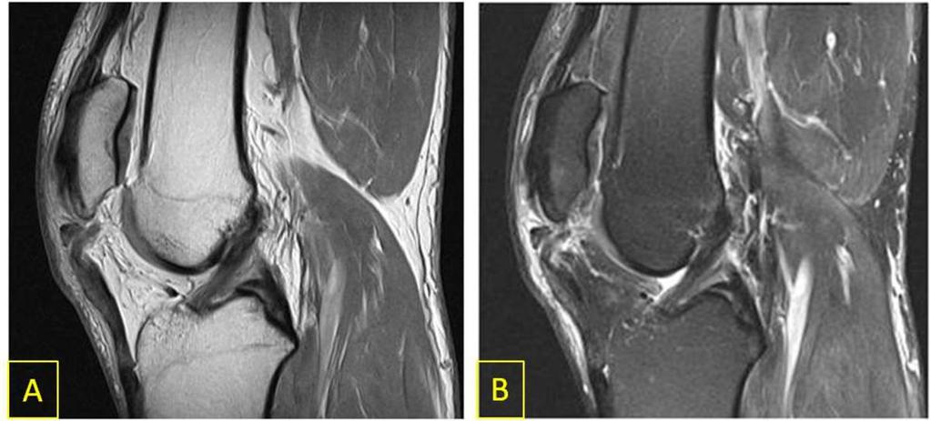 Fig. 3: ANSWER: MRI demonstrates patellar tendon rupture with edema in Hoffa's fat pad