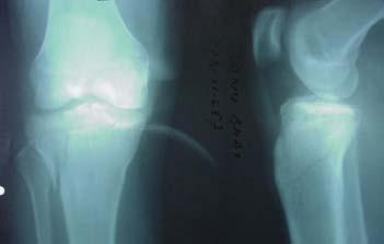 the treatment of proximal tibial articular fracture includes restoration of articular congruity, axial