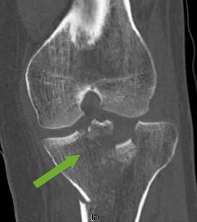 Clinical cases / Tibial plateau Graftys By Pr Sebastien Parratte A complex plateau tibial fracture due to a fall in ski Hypothesis: Using an injectible calcium phosphate bone