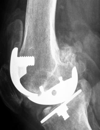 Where to use QuickSet? Revision Fracture To fill osteolytic lesions and bone defects.
