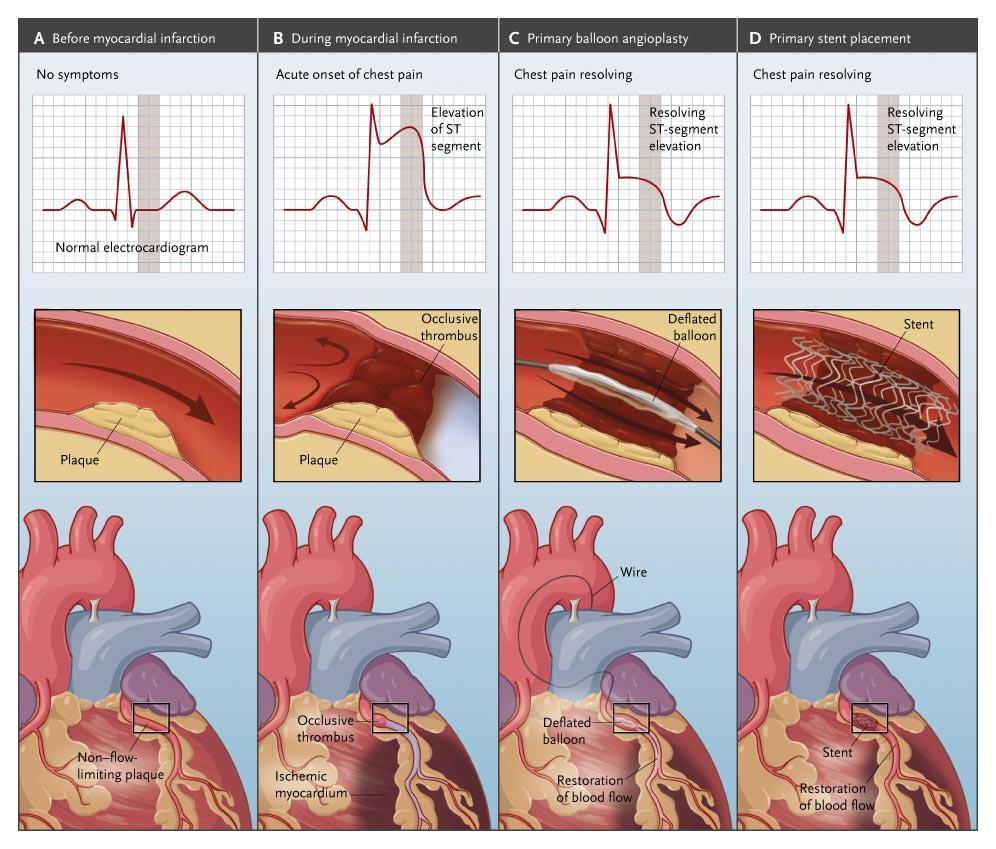 ST segment elevation MI (STEMI) - Characterised by specific ECG changes due to total occlusion of a coronary