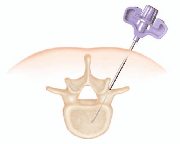 Surgical Technique Needle Placement The trajectory by which the needle is inserted varies depending on the vertebra to be treated.