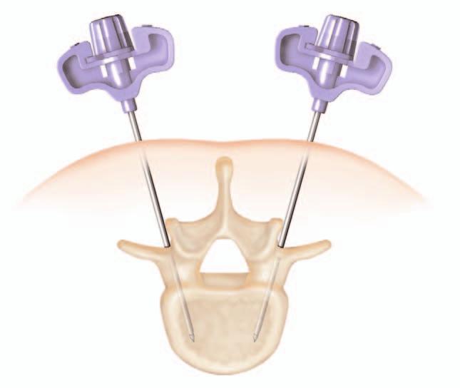 Using alternating A/P and lateral fluoroscopy the needle can be guided into the vertebral body.