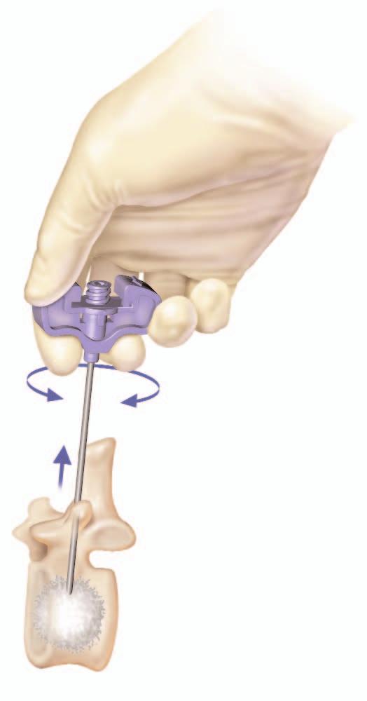 Remove the introducer needle from the vertebral body by rotating and pulling the needle.