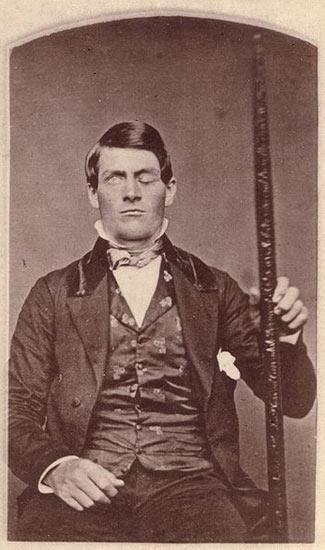 Phineas Gage (1823 1860) The first case suggesting that damage to specific regions of the brain might affect