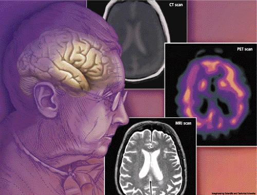 Dementia Dementia means brain failure, the inability of the brain to function normally Refers to a loss of