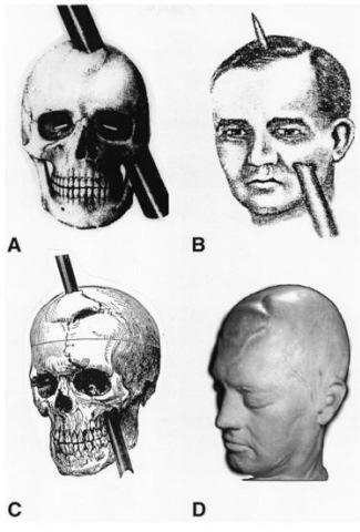 Phineas Gage Play The Frontal Lobes and Behavior: The Story of Phineas Gage (12:03) Module #25 from