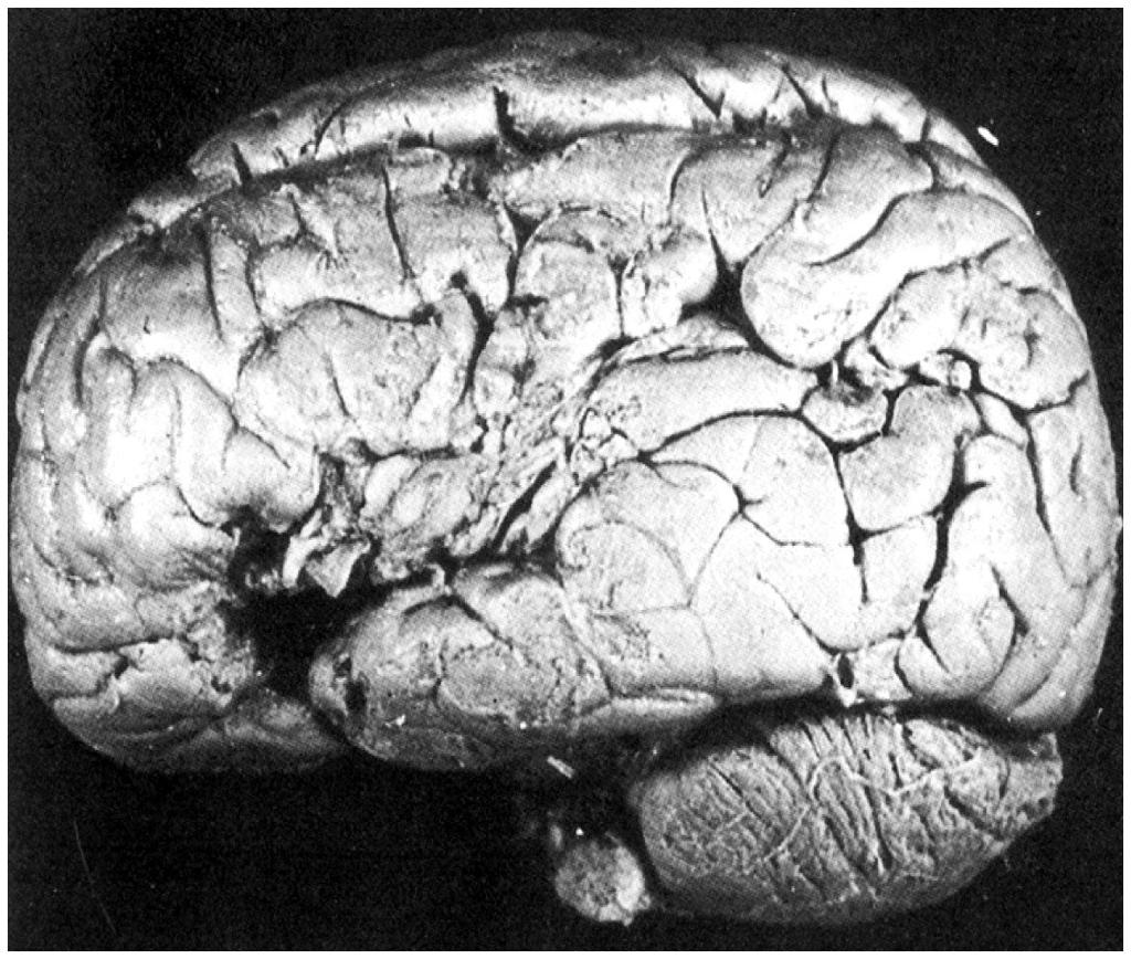 Broca s Area This is the brain of Tal from whom Broca
