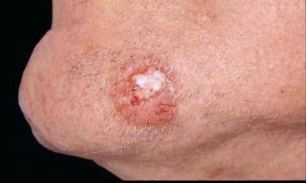 1 Epidemiology Basal cell carcinoma Basal cell carcinoma (BCC) is the most common malignant neoplasm in white populations.