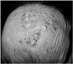 Skin Cancer Fernando Vega, MD Seattle Healing Arts Clinical characteristics Precancerous lesions Common skin cancers ACTINIC KERATOSIS Precancerous skin lesions Actinic keratoses Dysplastic