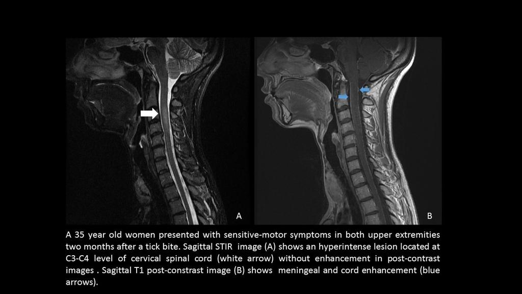 Fig. 6: Myelopathy and leptomeningeal enhancement in the spinal cord