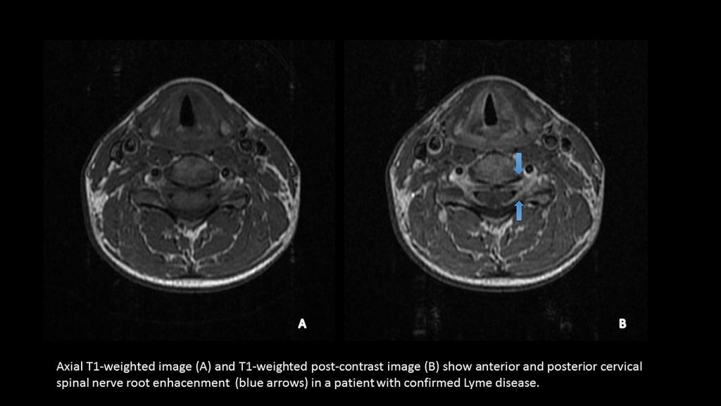 Fig. 4: Cervical nerve-root enhancement in a patient with confirmed Lyme