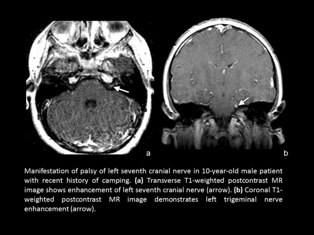 Fig. 5: Cranial nerve enhancement in a suspected Neuro-Lyme disease.