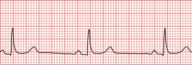 Pediatrics Arrhythmias in Children: Bradycardia and Tachycardia Diagnosis and Treatment See online here The most common form of cardiac arrhythmia in children is sinus tachycardia which can be caused