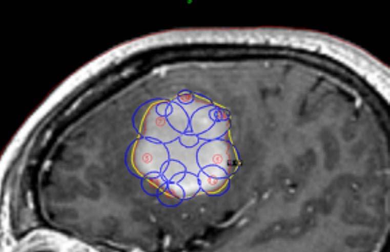 Gamma Knife: Dosimetry SHOTS: spheres of dose Pack shots into irregular shaped targets MRI/CT/Angio Rarely contour Never add a margin Prescribe to 50% isodose line Not concerned