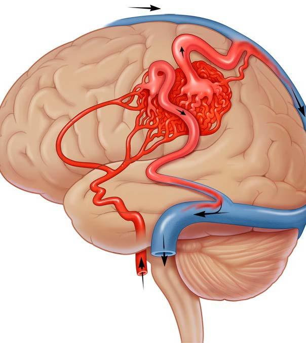 Arteriovenous Malformations (AVM) Abnormal collection of blood vessels bypassing