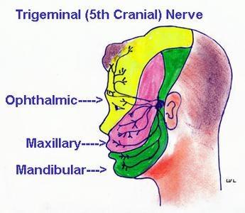 Trigeminal Neuralgia (TN) Lancinating Pain in distribution of CN V