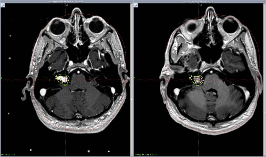 Vestibular Schwannoma Acoustic neuroma Benign tumor of the vestibulochochlear nerve (CN 8) 3000 per year in US