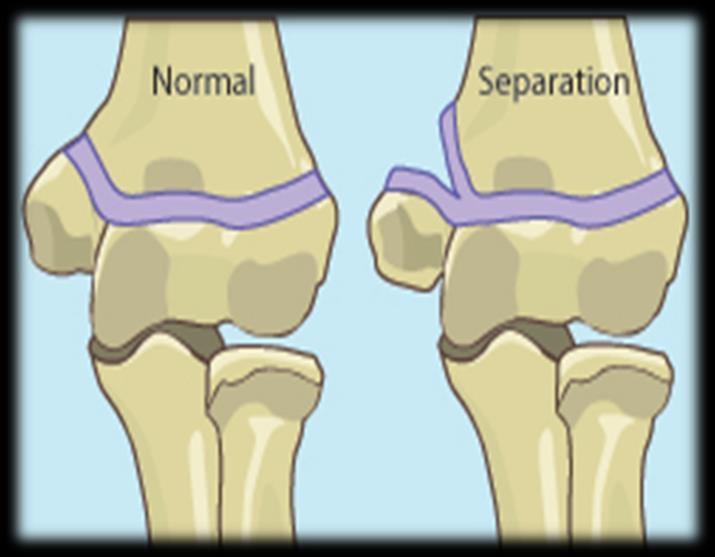 Avulsion of the epiphysis of the medial epicondyle is also common in childhood There is a line on this bone which is the Epiphyseal plate it is a line that connects between the epiphysis and the