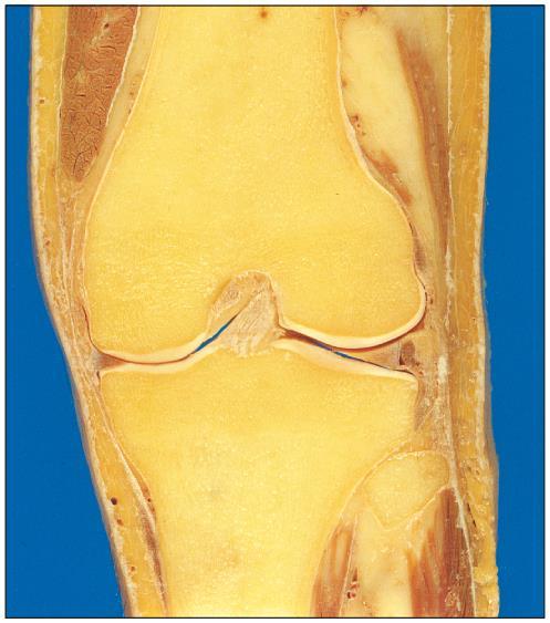 Knee Joint (b) Femur Anterior cruciate Lateral condyle Lateral meniscus Articular cartilage Lateral condyle Head of fibula Tibia Fibula Femur Lateral