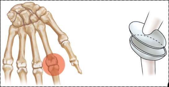 Types of Synovial Joints Ball & Socket/spheroidal Joint Hip joint