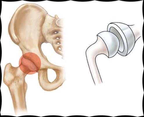 phalanges Between radius and carpals Hip bone Head of femur in