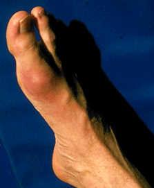 Clinical picture (I) Recurrent attacks of acute, very painful, monoarticular inflammation Podagra is the classic symptom (gout affecting the big toe) Other common sites are foot, ankle, knee, finger,