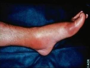 Alternative diagnostic approaches A presumptive diagnosis of gout may be made in the absence of synovial fluid aspiration if the patient has a Typical presentation