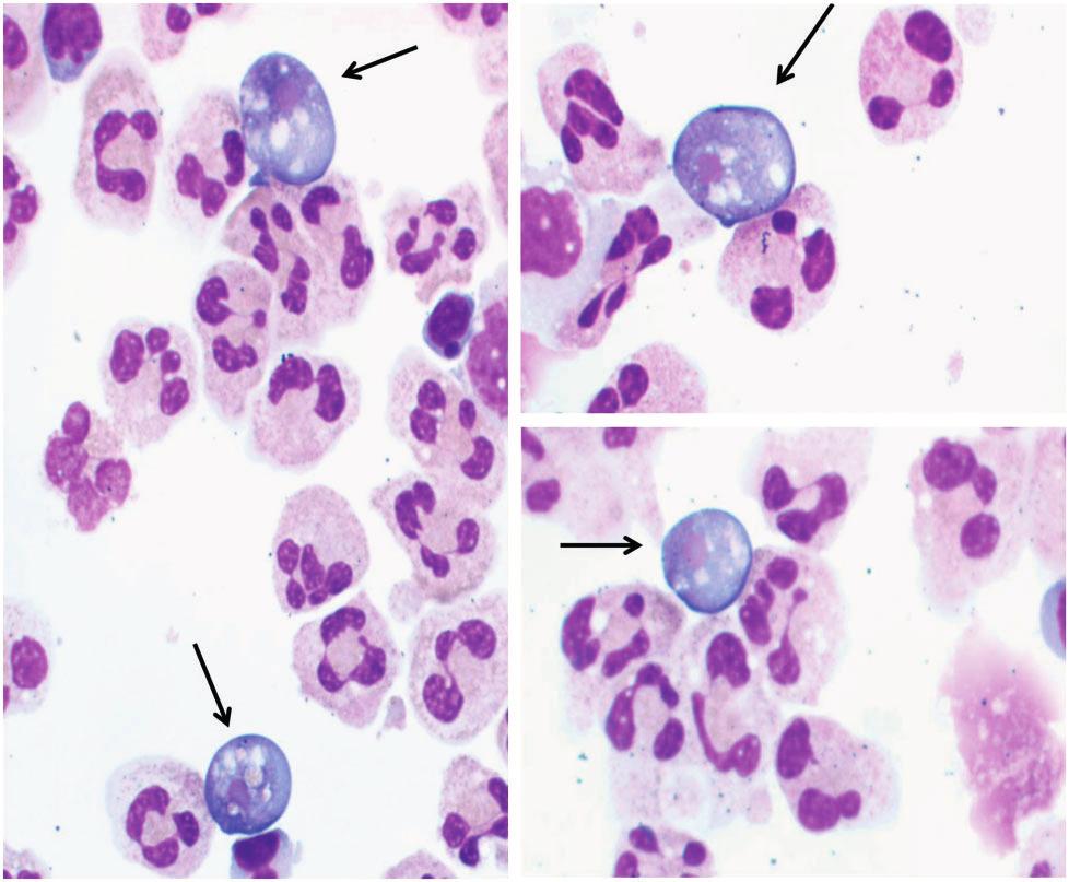 Image 1 Naegleria fowleri on Wright-Giemsa stained cerebrospinal fluid cytospin slides (original magnification, 1000; oil immersion). Arrows indicate Naegleria organisms.