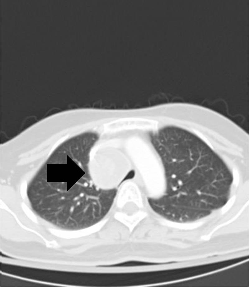 axial view of enhanced chest CT showed a 4-cm necrotic
