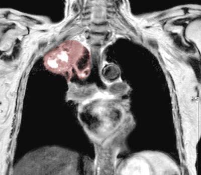com/eye/ Pancoast Tumor seen on MRI Right Horner s