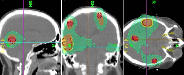 Radiotherapy of brain mets