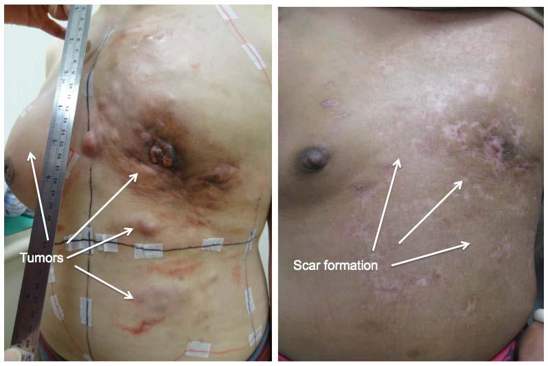 skin mets 導航螺旋刀安全有效地治療乳癌大範圍胸腹壁病灶及疼痛