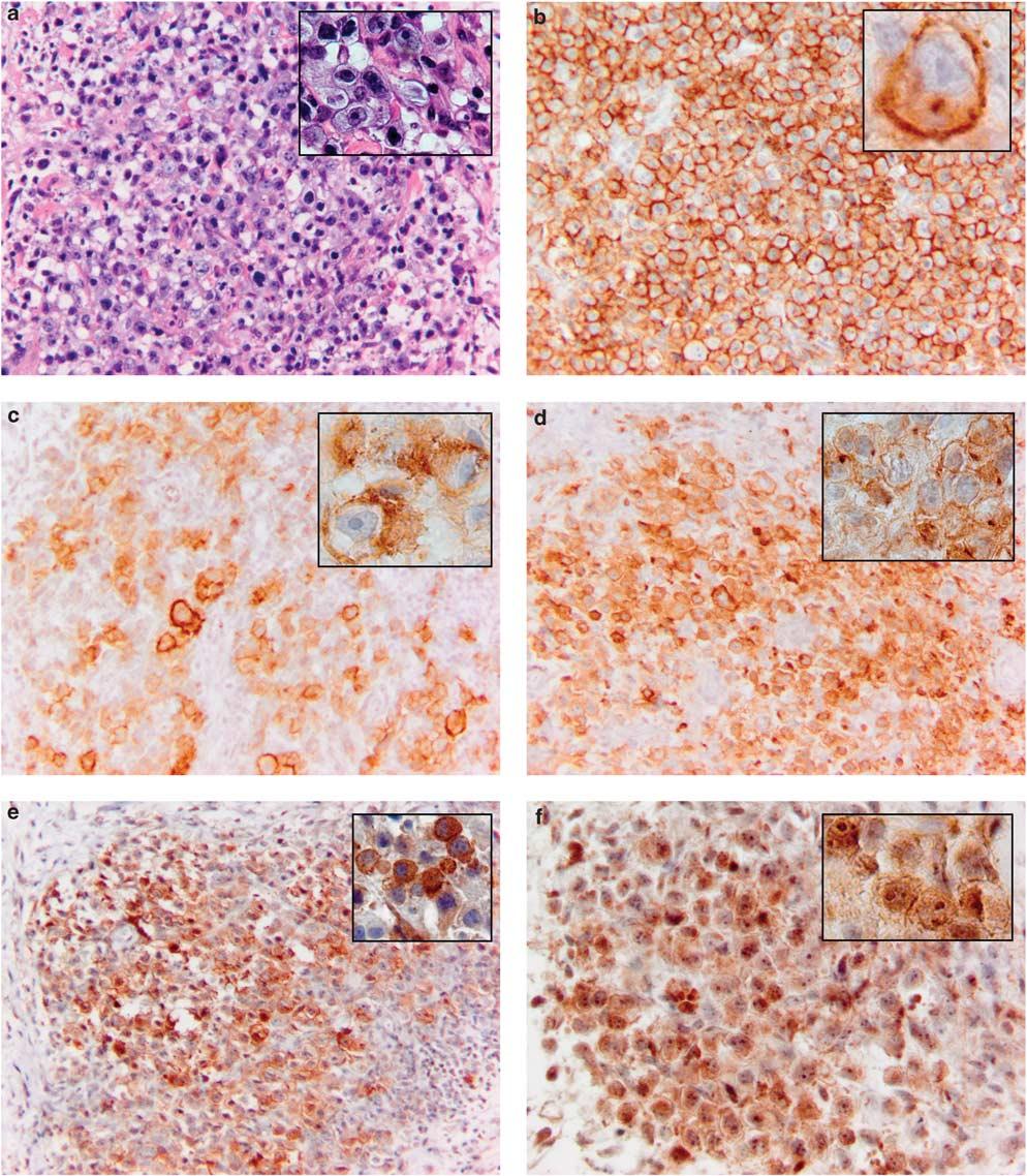 1640 DM Dorfman et al Figure 1 Primary mediastinal large B cell lymphoma (a) contains sheets of medium to large-sized neoplastic cells with round to oval nuclei, pale cytoplasm and associated