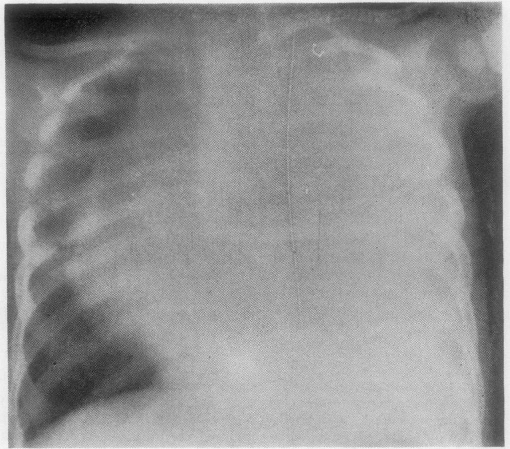 475 on 1 July 1974. Downloaded from http://thorax.bmj.com/ FG. 2. A 2-year-old child with fever, cough, and severe dyspnoea of 40 days' duration.