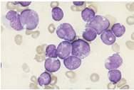 Intravascular large B-cell lymphoma ALK+ large B-cell lymphoma Plasmablastic lymphoma Large BCL, HHV8+ ex.