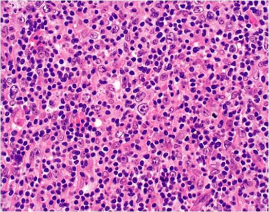 Large B-cell Lymphomas Subtypes