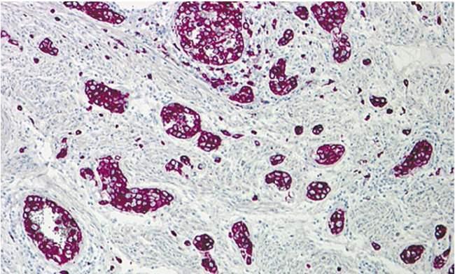 CD79 Plasmablastic B-celI Lymphoma