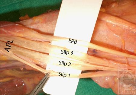 Figure 2. Intracompartmental septation within the first dorsal compartment for the extens Figure 3. Slip multiplicity of the abductor pollicis longus tendon.