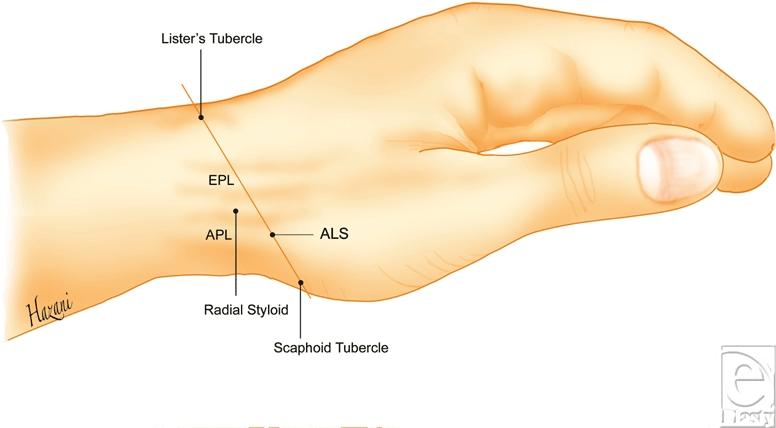 57 cm distal to the distal aspect of the extensor retinaculum. Therefore, the proximal edge of the extensor retinaculum is approximately 2.51 cm proximal to the radial styloid.