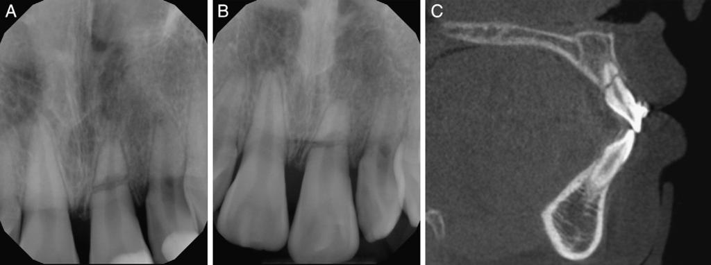 Figure 2. In a 13-year-old patient a root fracture can be seen in the middle root canal third (A and B). The sagittal CBCT slice clearly shows the presence of a single fracture (C). Figure 3.