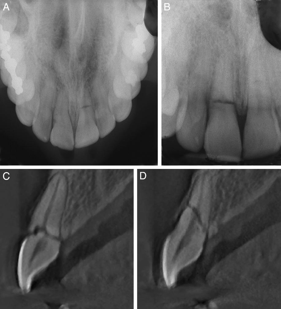 On the periapical radiograph of the same patient, a root fracture is visible in the cervical third of the right central maxillary incisor (B).