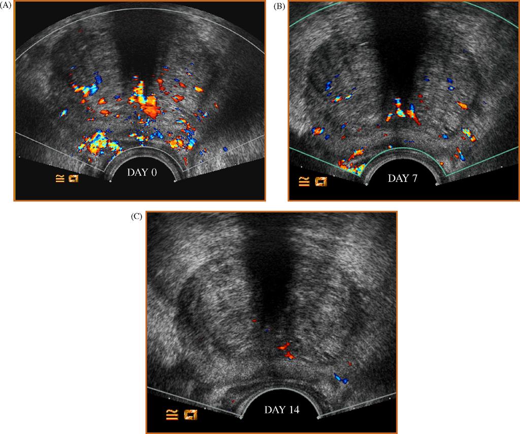 european urology 53 (2008) 112 117 115 Fig. 1 Transverse ultrasound (US) images of prostate in 74-yr-old man with an elevated prostate-specific antigen level.