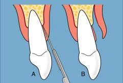 The aim of this article is to inform clinicians who are interested in new periodontal plastic surgical methods and to focus on a novel procedure that is highly successful in treating adjacent
