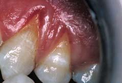 A Promising Periodontal Procedure for the Treatment of Adjacent Gingival Recession Defects Figure 5a: Severe gingival recession defects are present on the maxillary canine and first premolar.