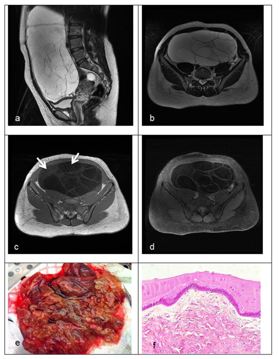 Fig. 1: Figure 1: Mucinous cystadenoma; unilateral multilocular ovarian mass without solid