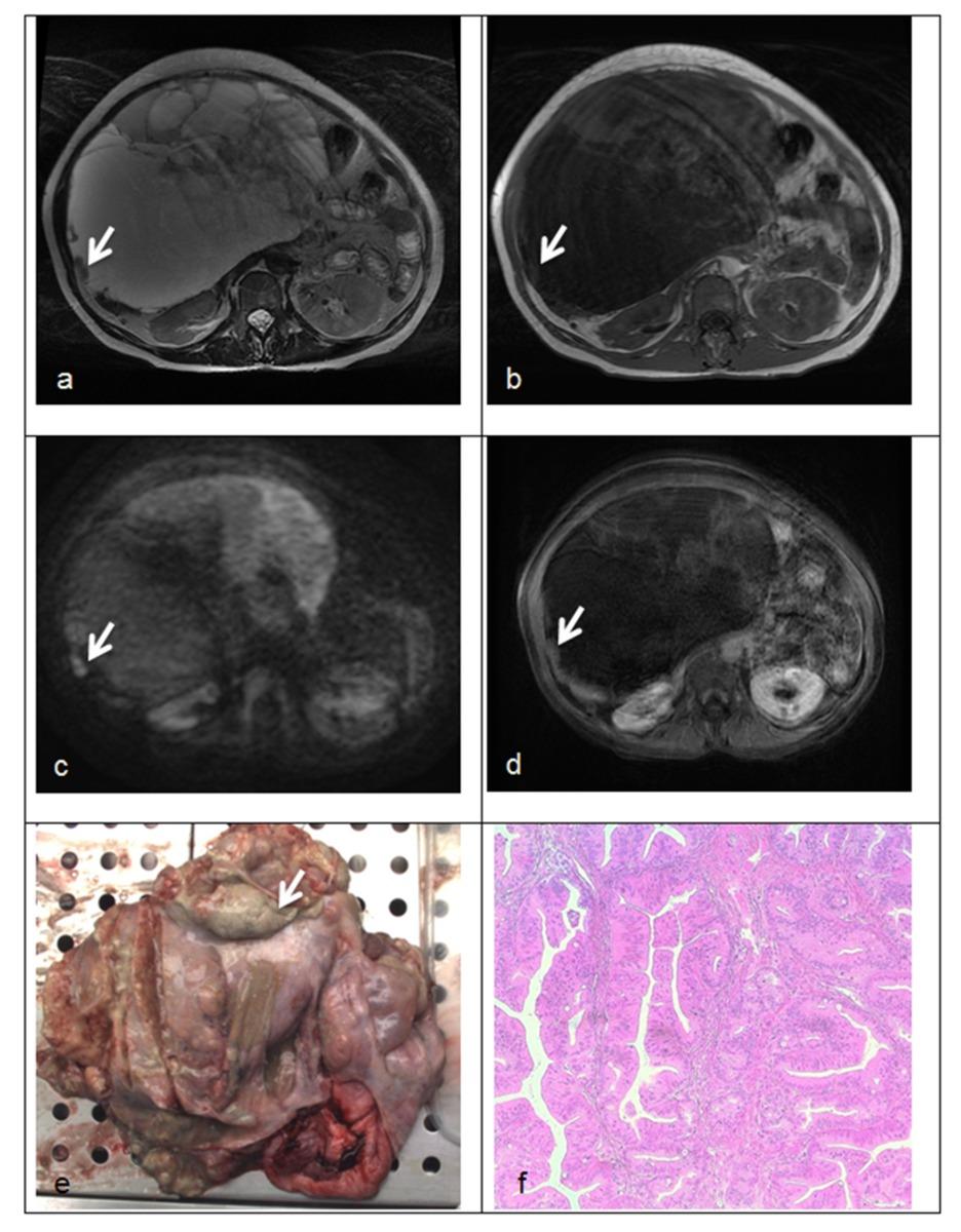 Fig. 3: Figure 3: Mucinous cystadenocarcinoma; Unilateral multilocular ovarian mass with solid portion (arrow).